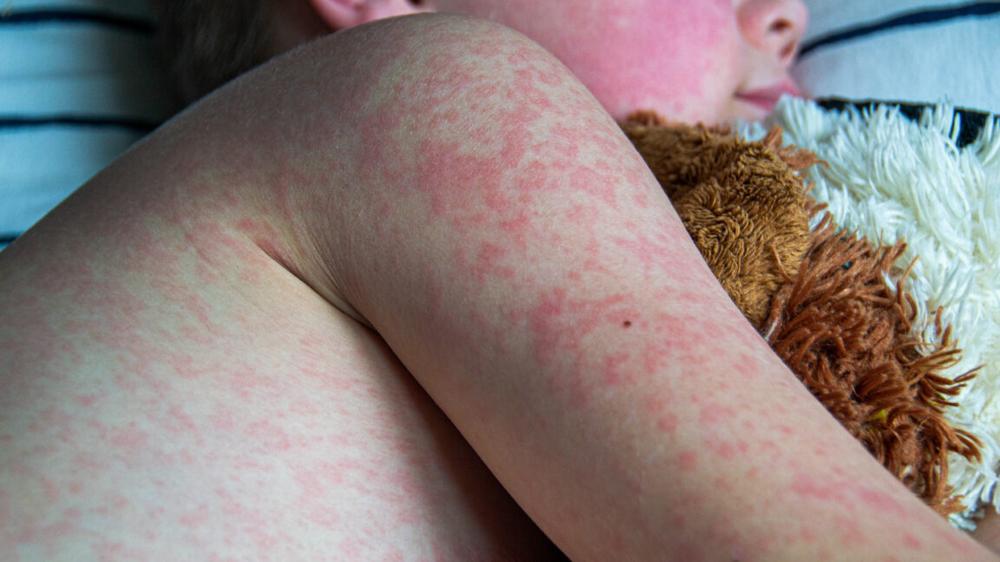 Measles cases reach 33-year high as RFK Jr. pursues anti-vaccine agenda