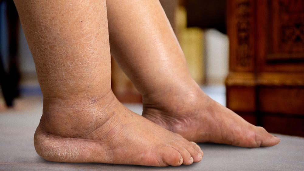 Trump Body Double Struggling To Get Leg Edema Just Right