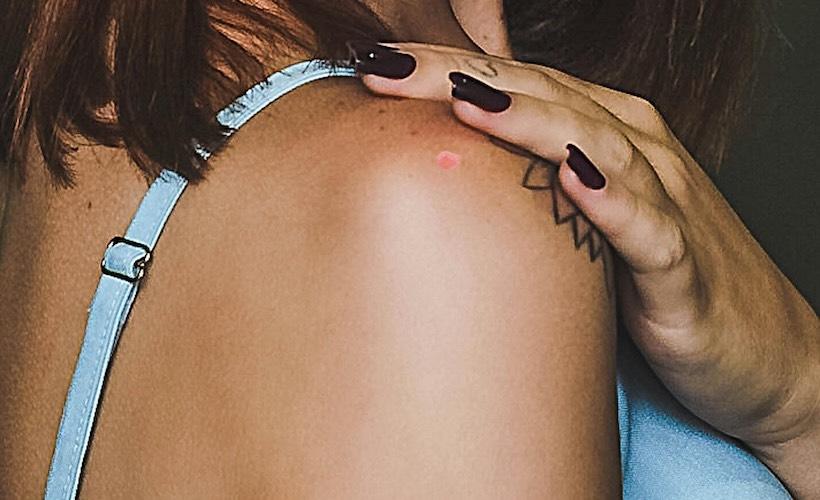 Adventurous Zit Studies Abroad on Shoulder