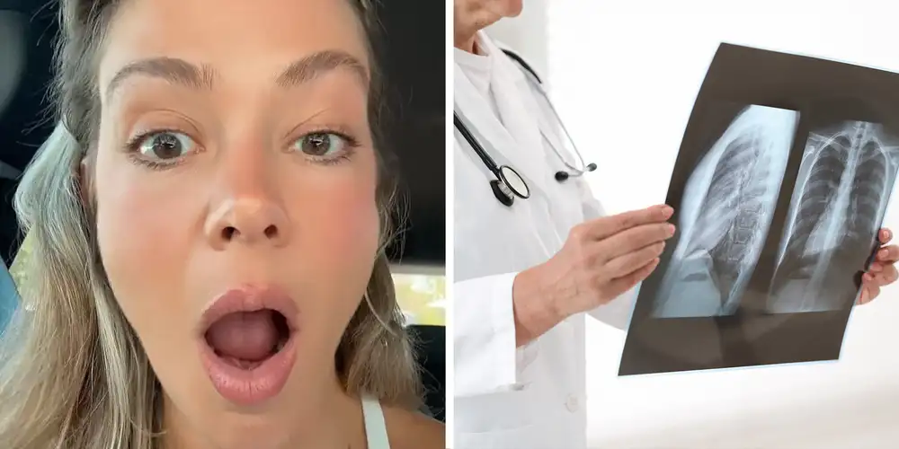 “I just finished wiping tears from my eyes”: Woman learns about the “never broken a bone theory.” Here’s what that is