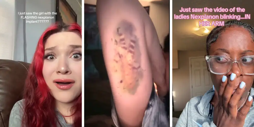 Everyone’s talking about this woman’s Nexplanon implant suddenly flashing and blinking