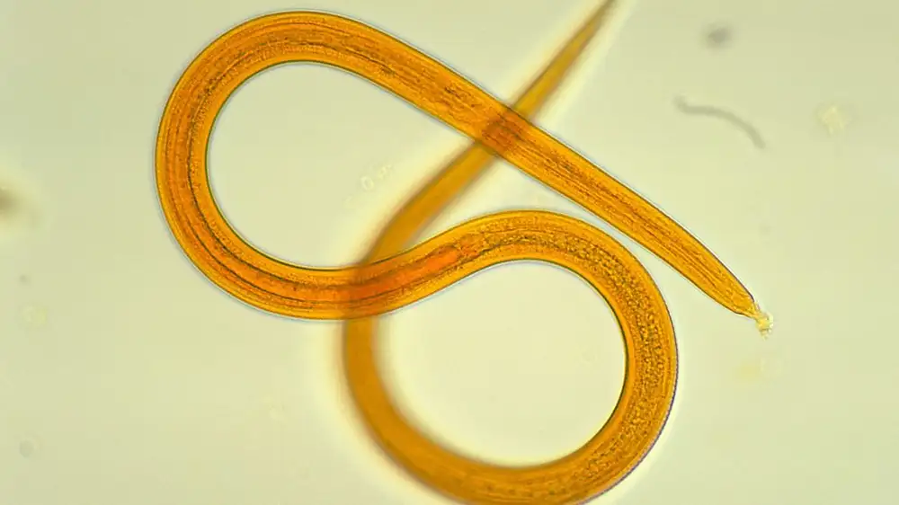Man’s health crashes after getting donated kidney—it was riddled with worms