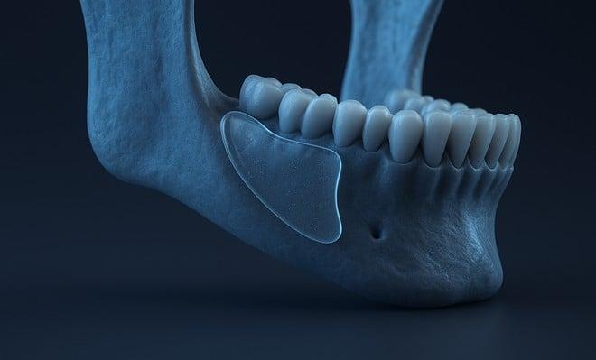Ossa di vetro? La stampa 3D apre la strada a impianti personalizzati