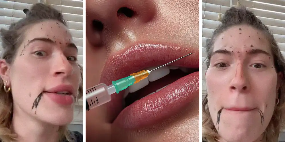 “Girlbossed too close to the sun”: People are injecting filler at home. Is it safe?